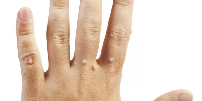 指の乳頭腫