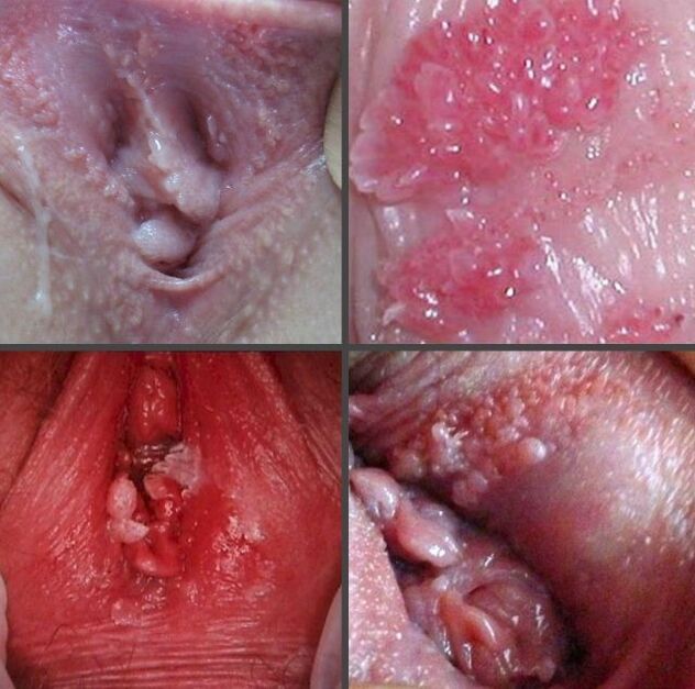 膣内の乳頭腫のクローズアップ