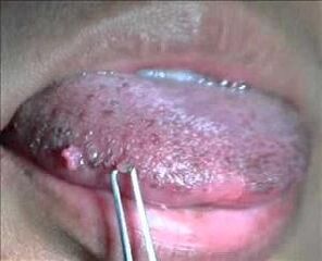 舌の上のヒトパピローマウイルス