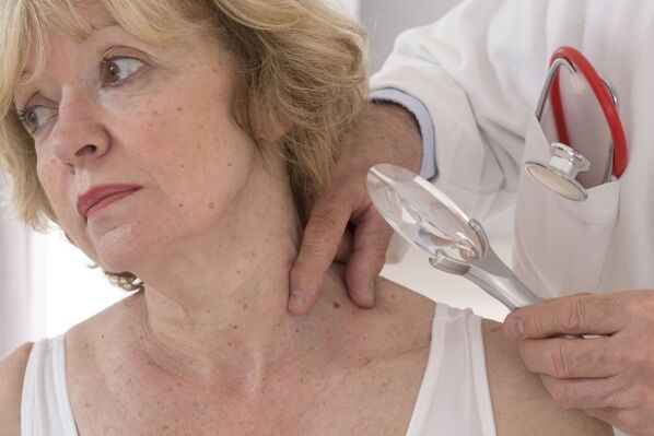 皮膚科医による乳頭腫の目視検査