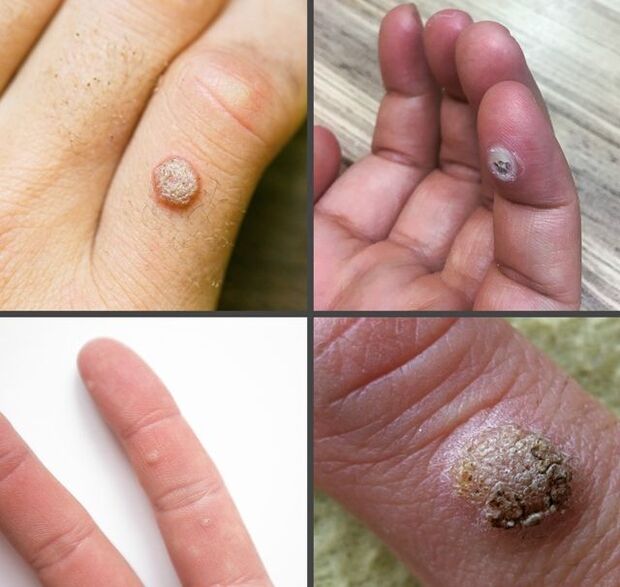 指のイボの一般的な種類
