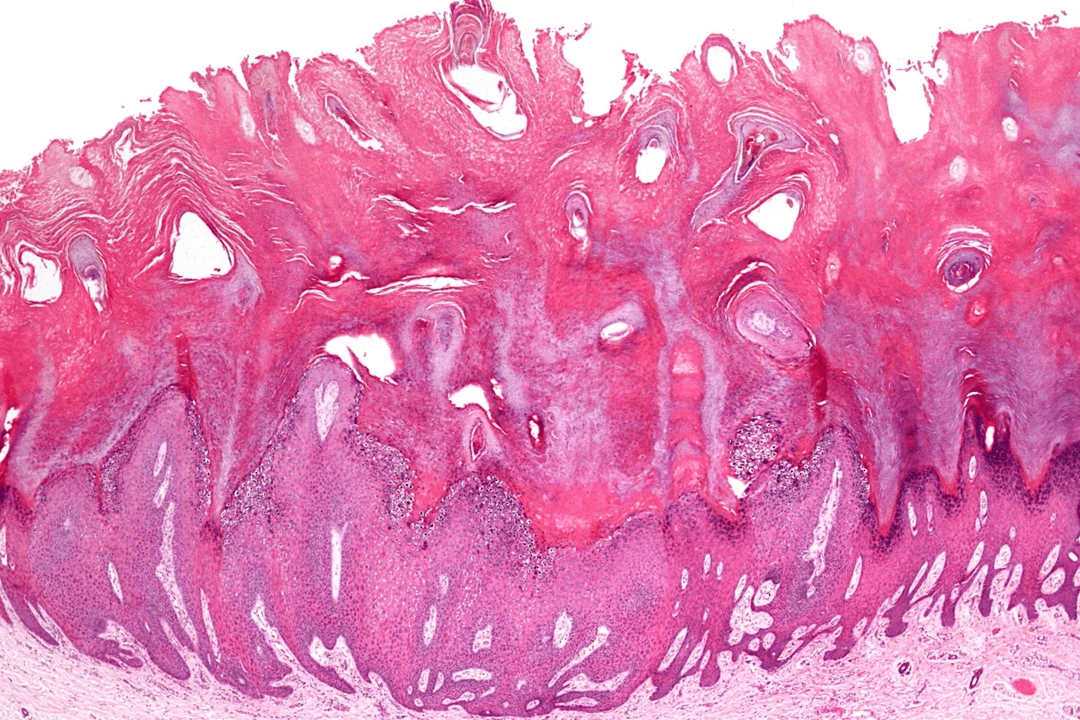 乳頭腫の発達段階