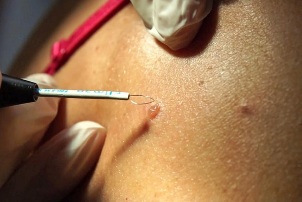 電波法による乳頭腫の除去